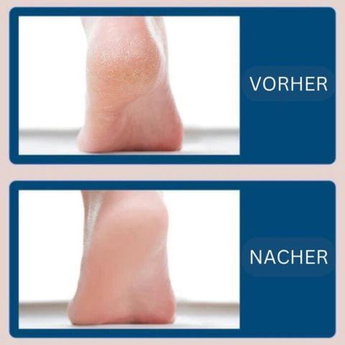 Pediküre Hornhautentferner elektrisch Fußpflege - Glamora Beauty